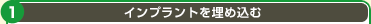 インプラントを埋め込む