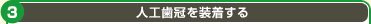 人工歯冠を装着する